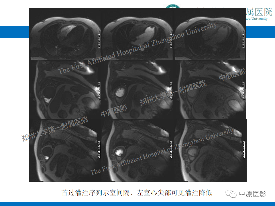 【病例】致心律失常性右室心肌病1例MR影像-30