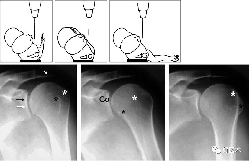 肩关节损伤的影像学诊断-12