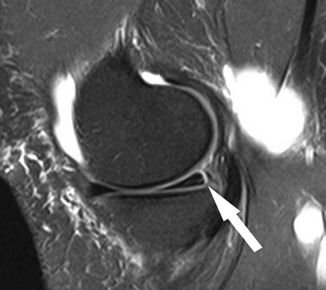 半月板Ramp损伤-4