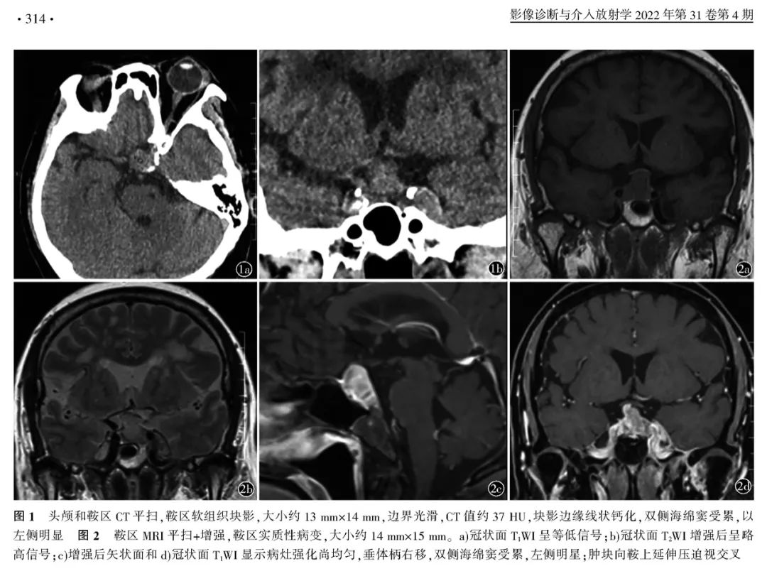 【病例】鞍区恶性肿瘤—非典型畸胎样/横纹肌样肿瘤1例CT及MR影像诊断思维-4