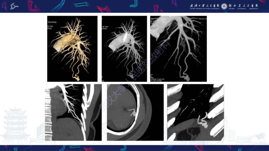 【PPT】肺动静脉畸形CT诊断-3