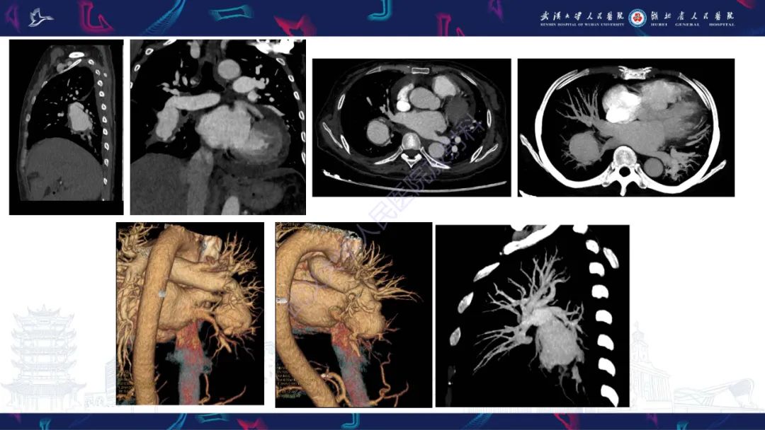 【PPT】肺动静脉畸形CT诊断-5