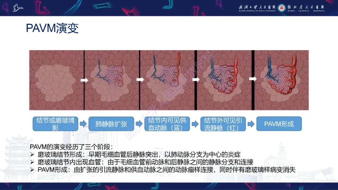 【PPT】肺动静脉畸形CT诊断-14
