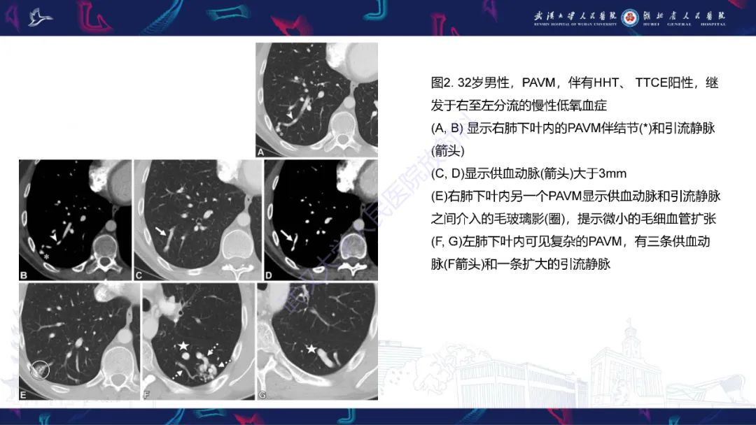 【PPT】肺动静脉畸形CT诊断-16