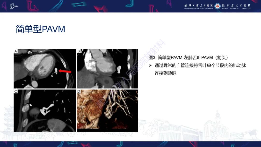 【PPT】肺动静脉畸形CT诊断-17