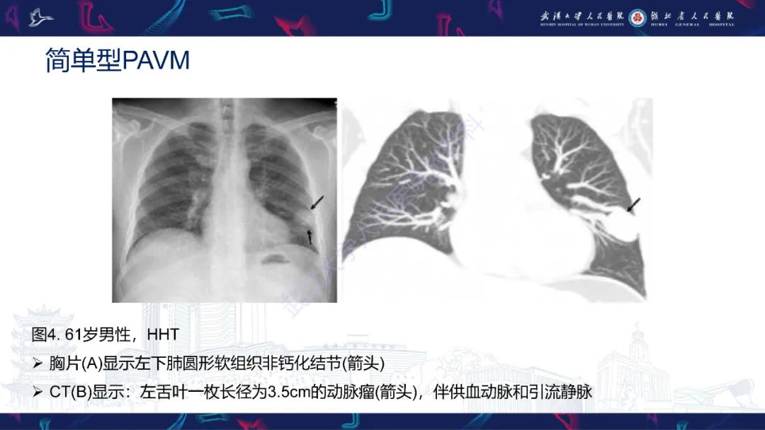 【PPT】肺动静脉畸形CT诊断-18