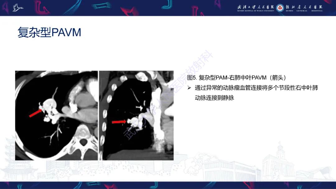 【PPT】肺动静脉畸形CT诊断-19