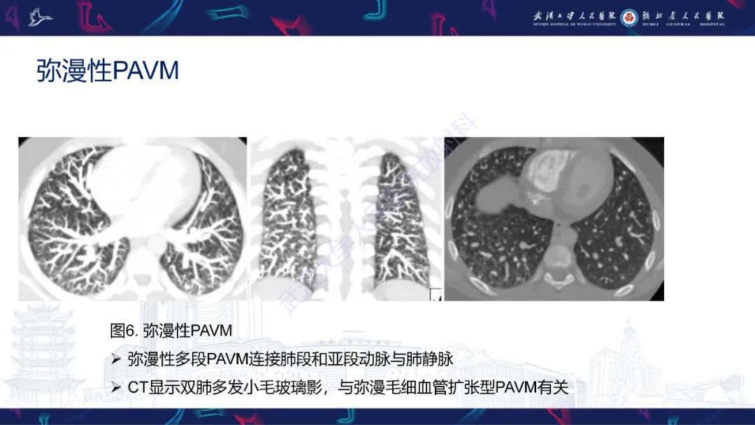 【PPT】肺动静脉畸形CT诊断-20