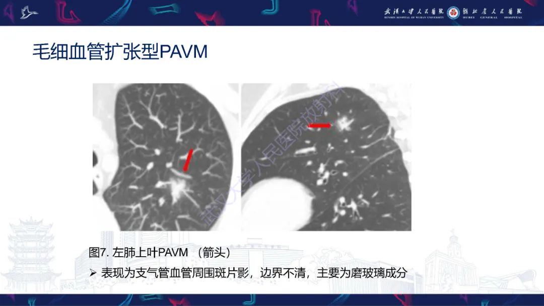 【PPT】肺动静脉畸形CT诊断-21