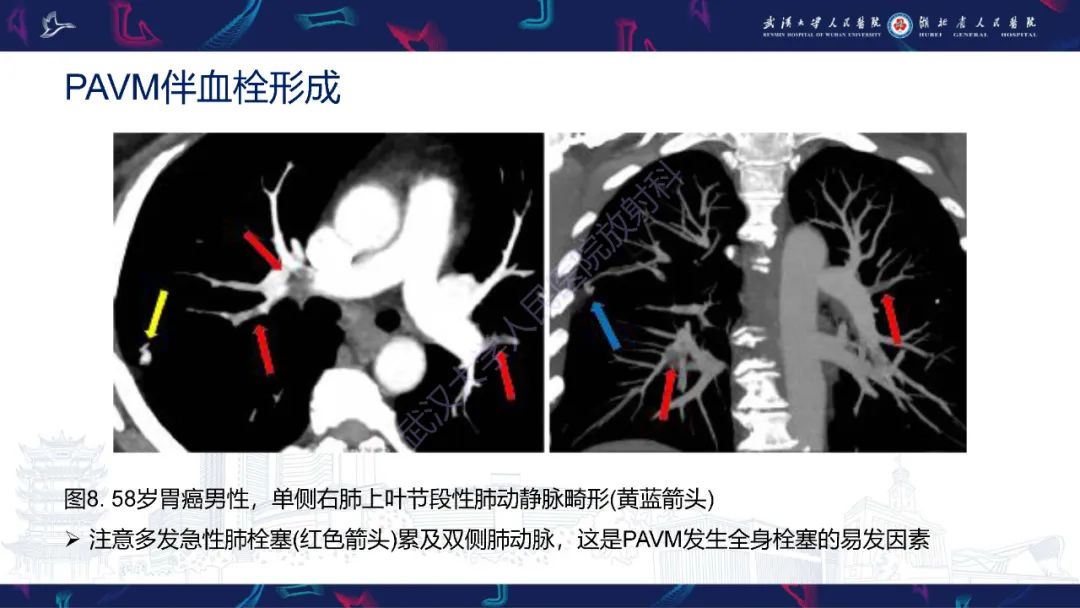【PPT】肺动静脉畸形CT诊断-22