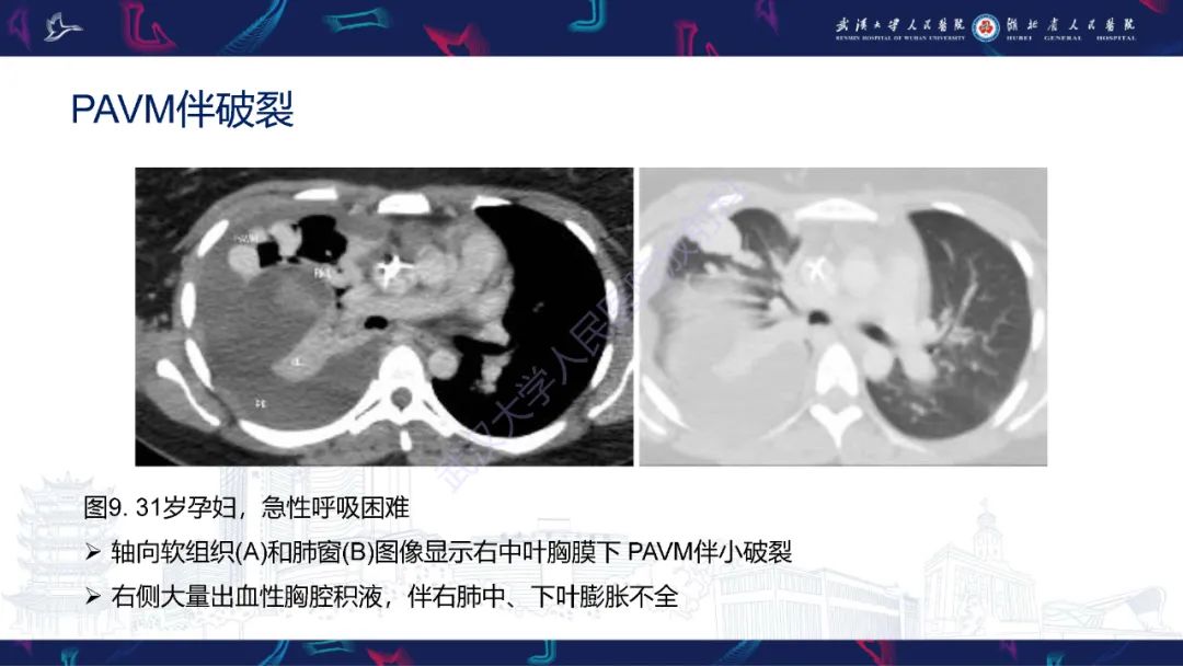 【PPT】肺动静脉畸形CT诊断-23