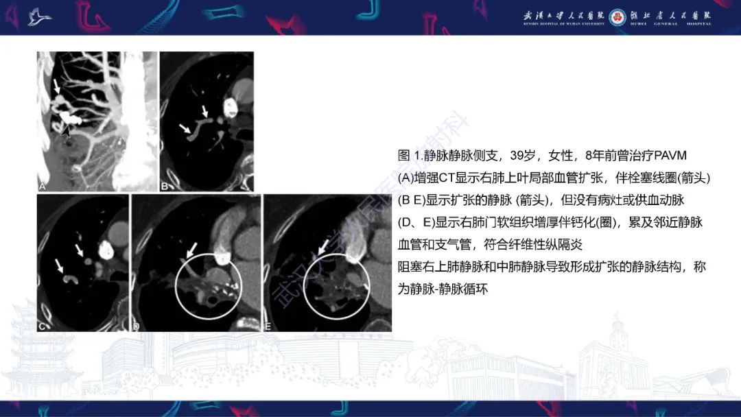 【PPT】肺动静脉畸形CT诊断-26