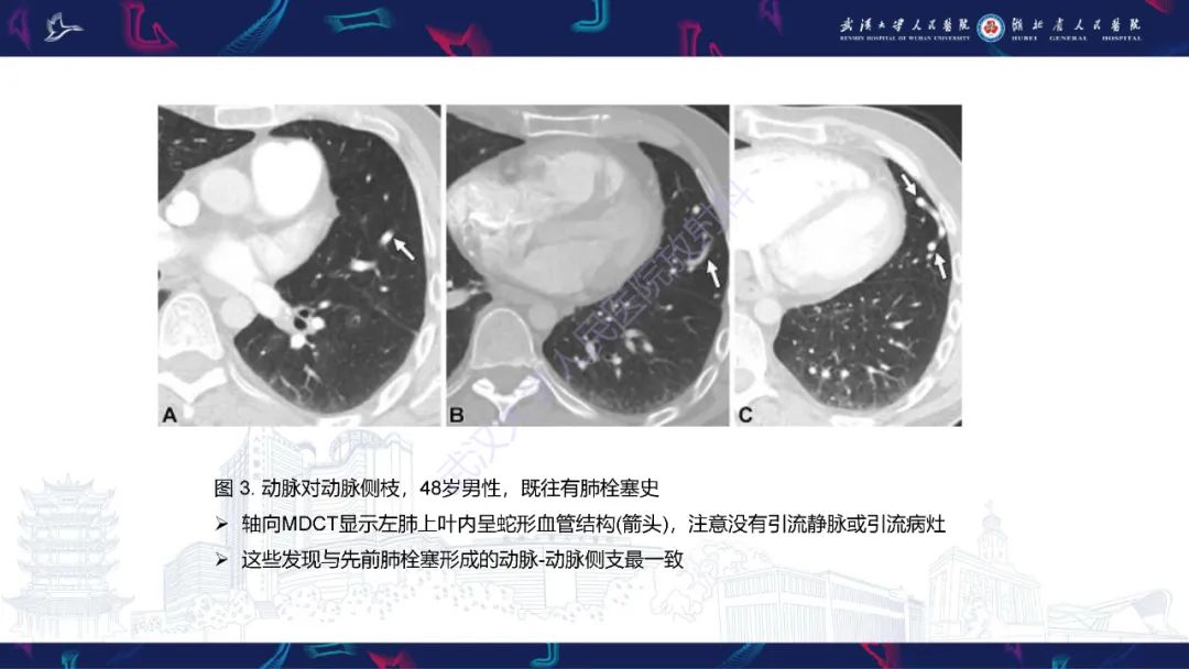 【PPT】肺动静脉畸形CT诊断-28