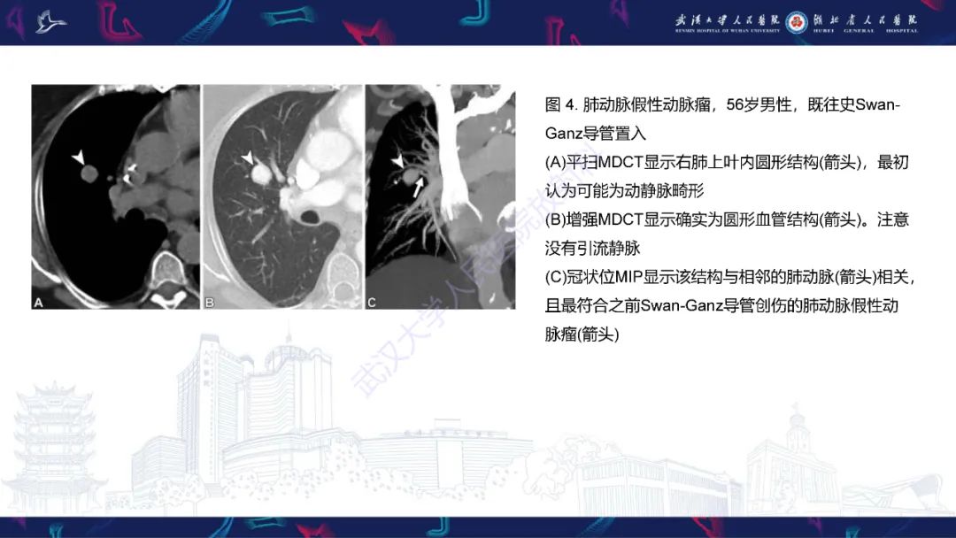【PPT】肺动静脉畸形CT诊断-30