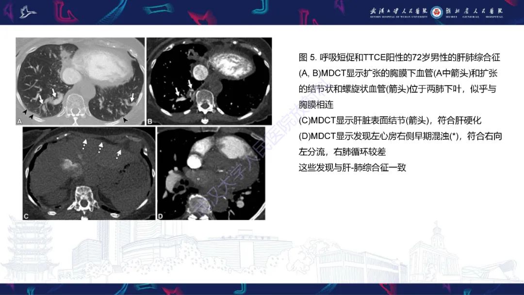 【PPT】肺动静脉畸形CT诊断-32
