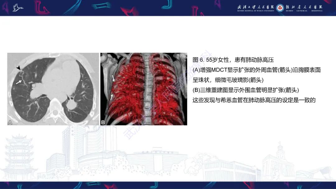 【PPT】肺动静脉畸形CT诊断-34
