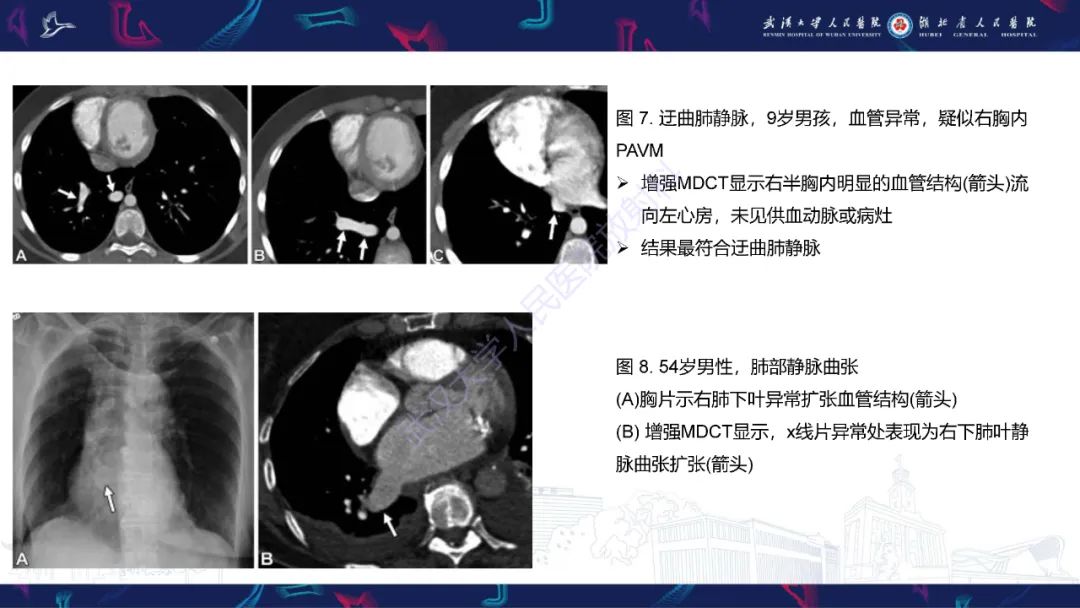 【PPT】肺动静脉畸形CT诊断-36