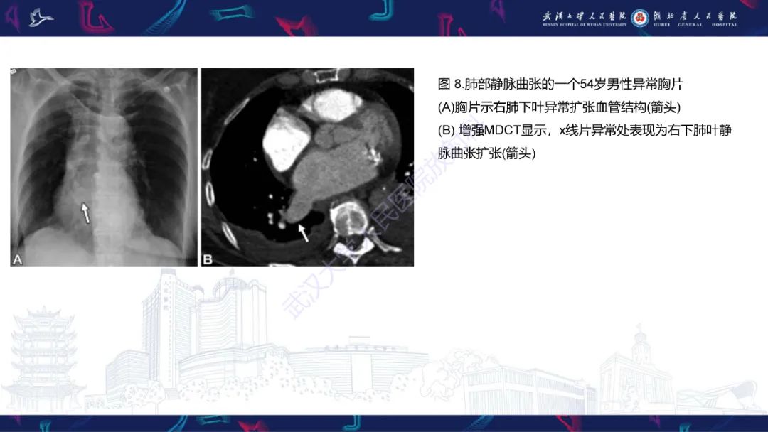 【PPT】肺动静脉畸形CT诊断-38