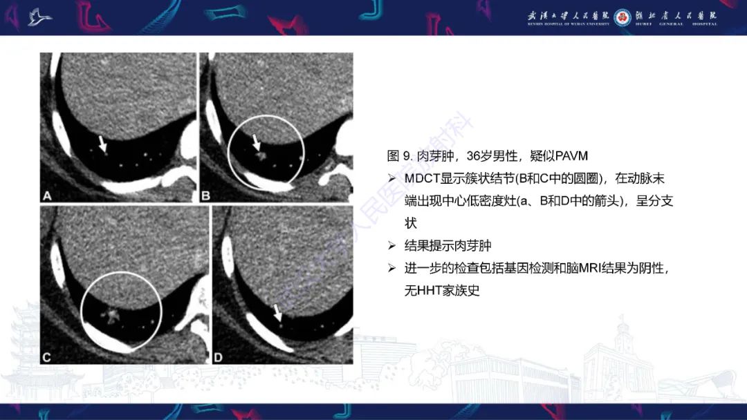 【PPT】肺动静脉畸形CT诊断-41