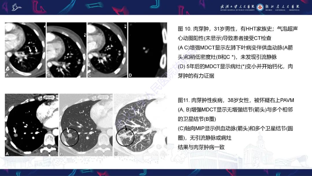 【PPT】肺动静脉畸形CT诊断-42