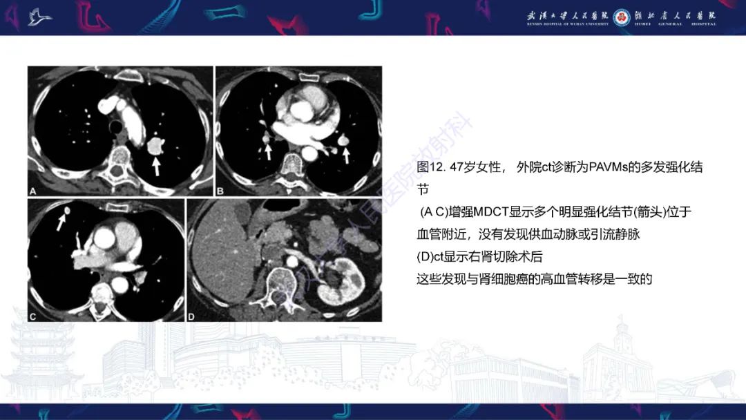 【PPT】肺动静脉畸形CT诊断-44