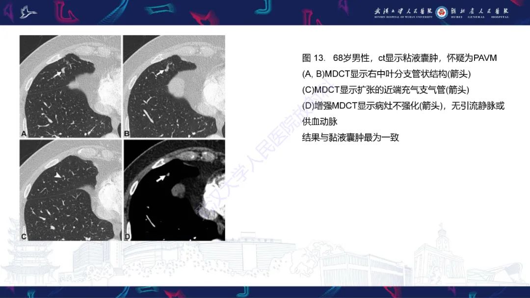 【PPT】肺动静脉畸形CT诊断-46