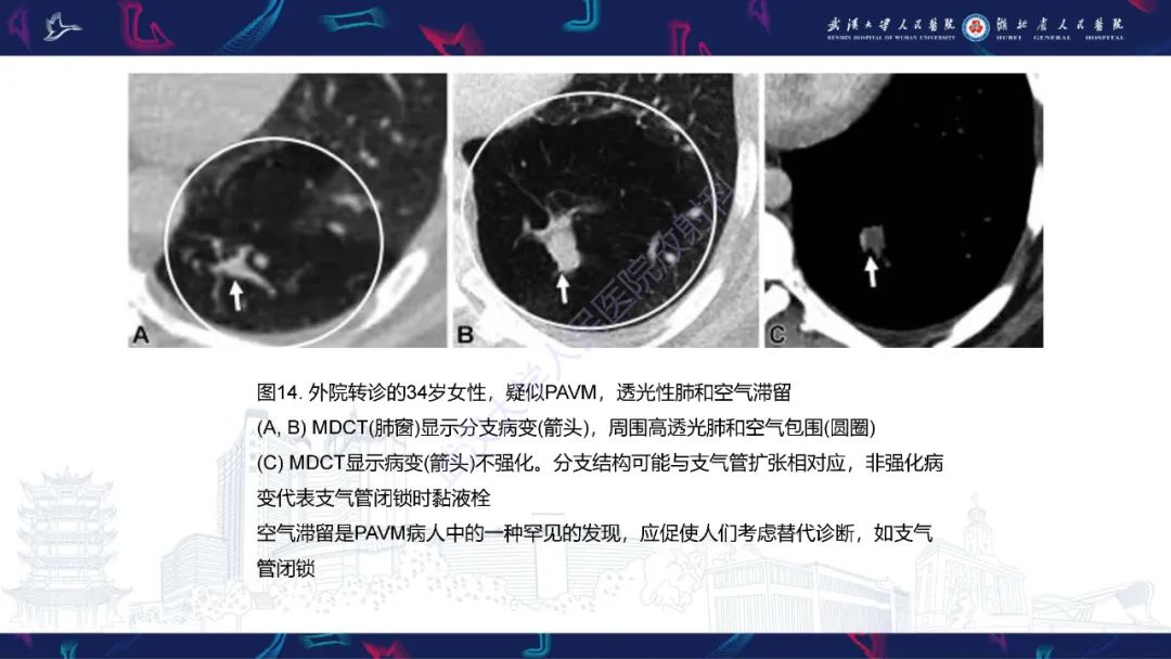【PPT】肺动静脉畸形CT诊断-47