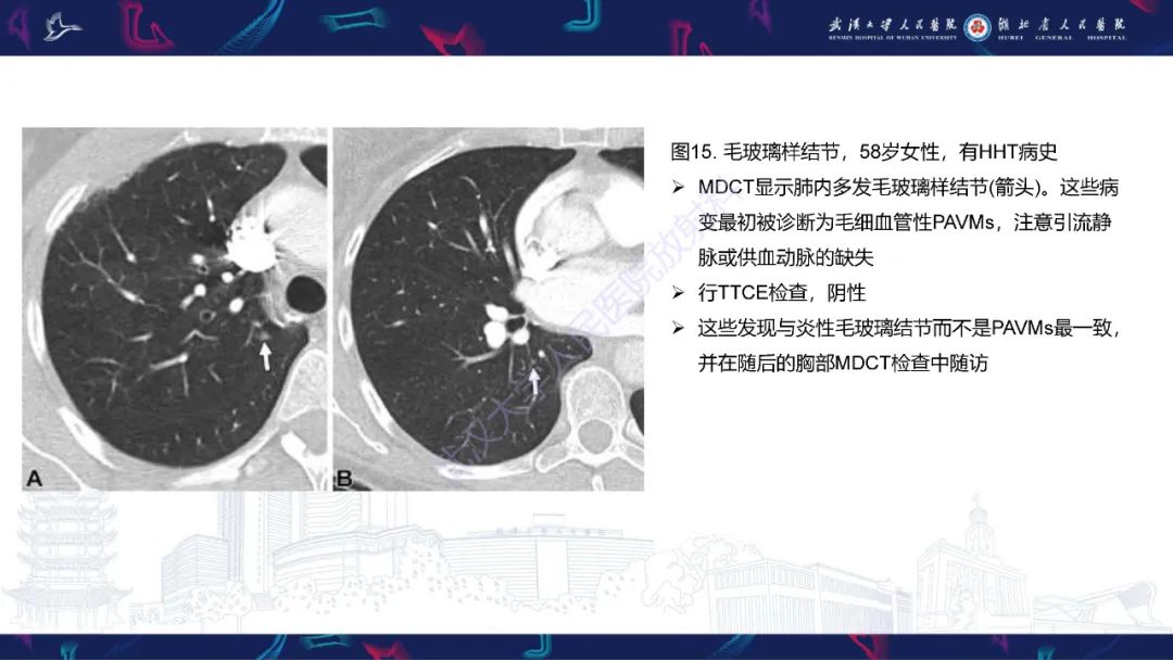 【PPT】肺动静脉畸形CT诊断-49