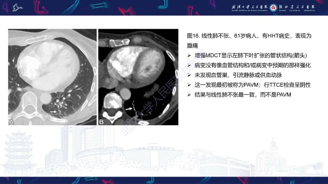 【PPT】肺动静脉畸形CT诊断-51