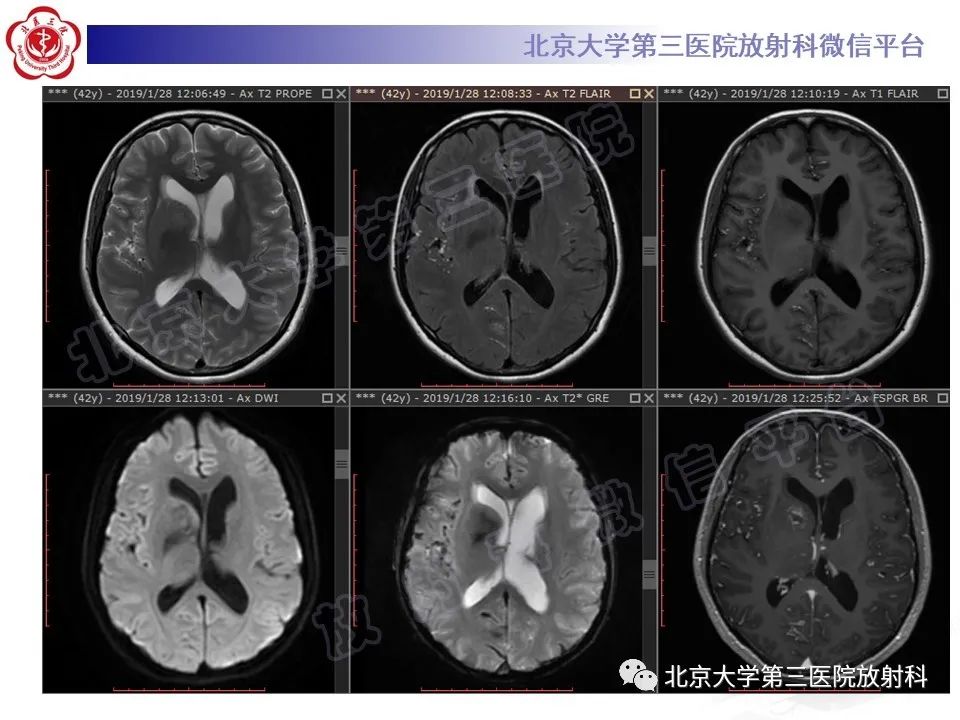 【PPT】颅内皮样囊肿-3