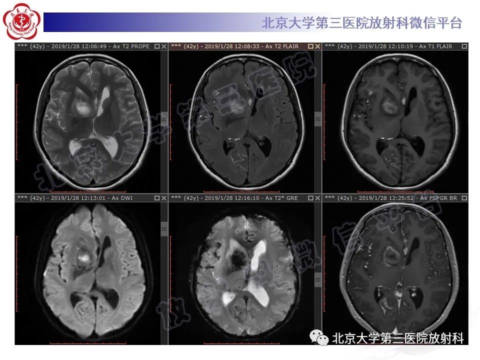 【PPT】颅内皮样囊肿-4