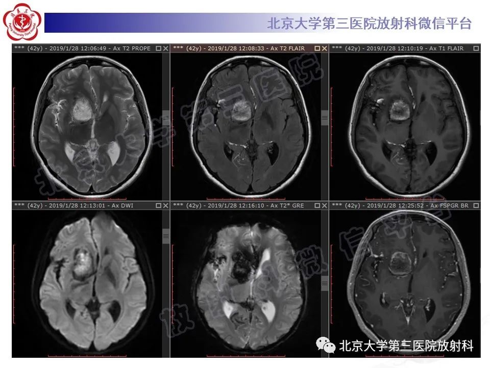 【PPT】颅内皮样囊肿-5