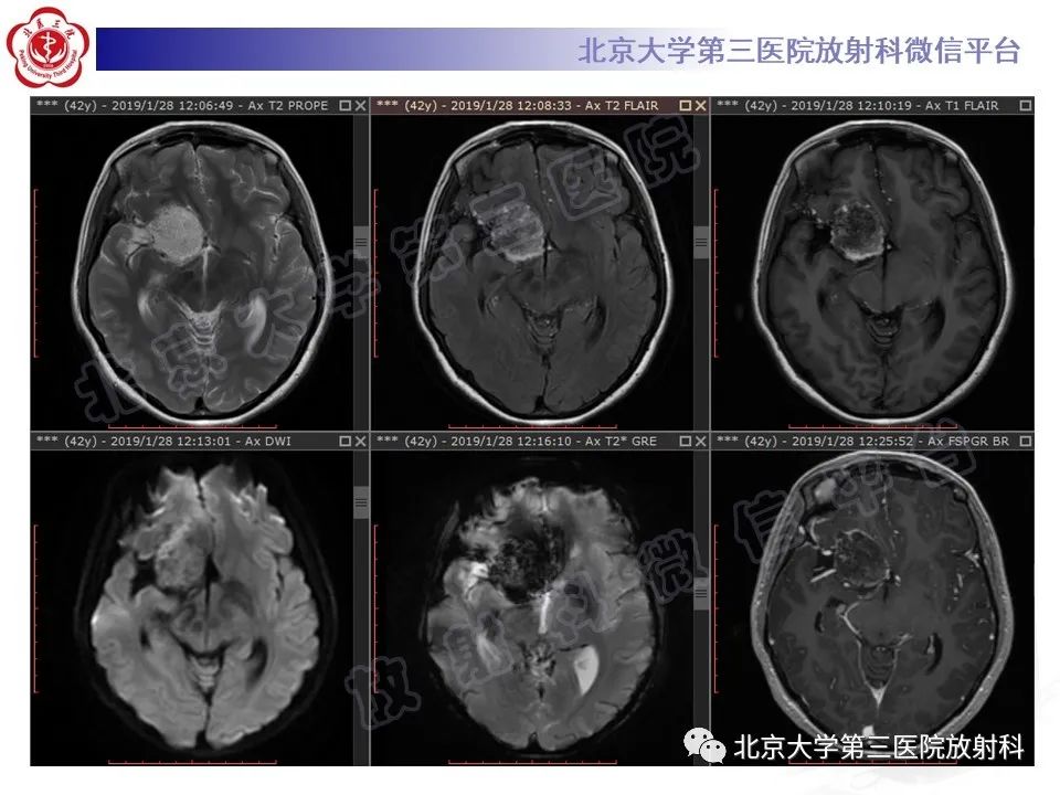 【PPT】颅内皮样囊肿-6