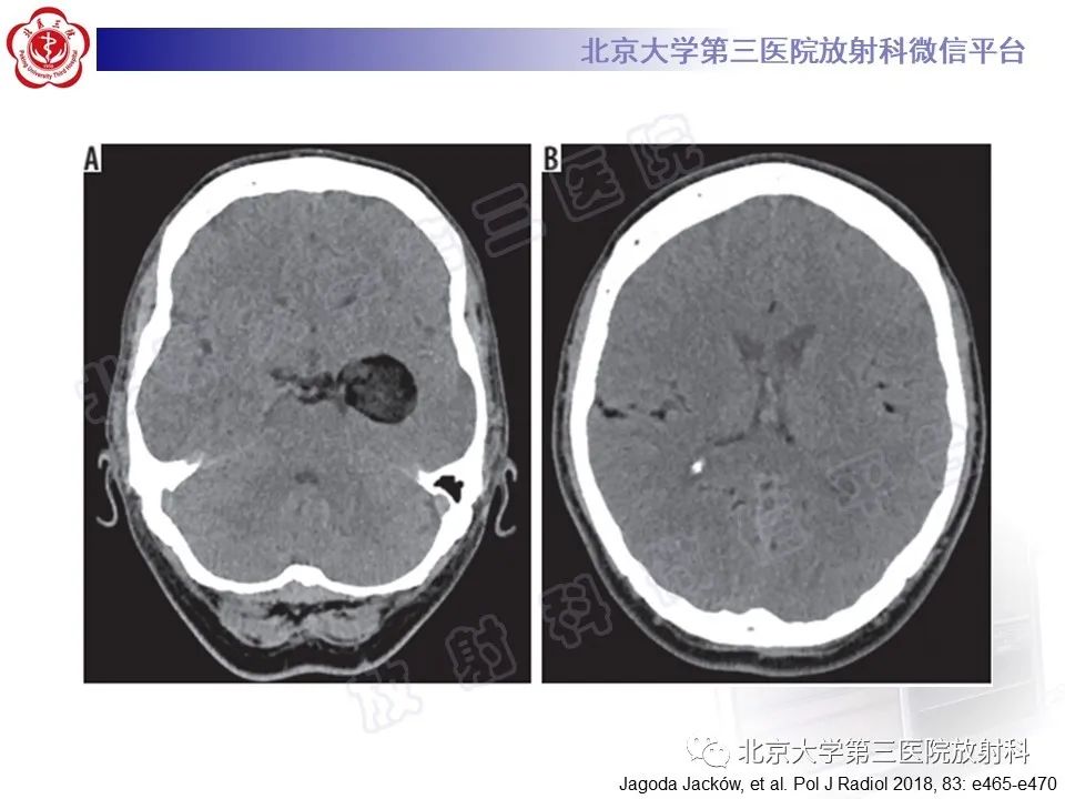 【PPT】颅内皮样囊肿-19