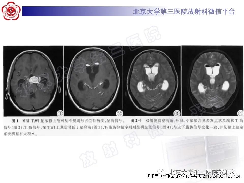 【PPT】颅内皮样囊肿-24