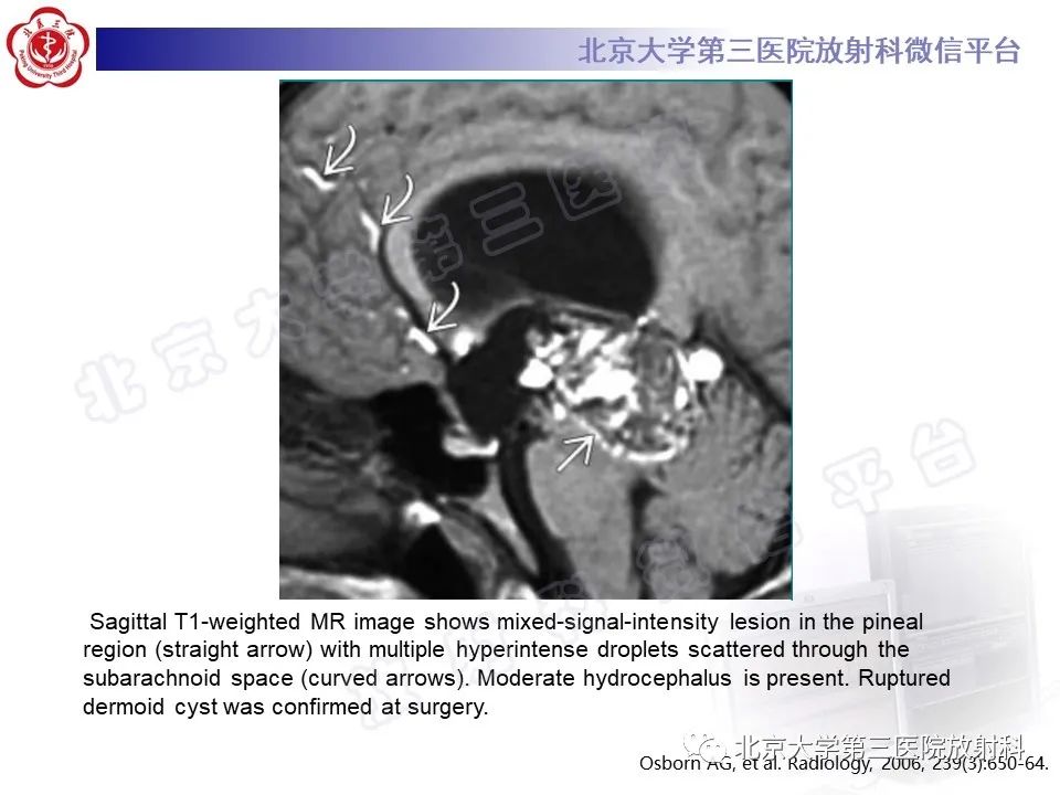 【PPT】颅内皮样囊肿-25