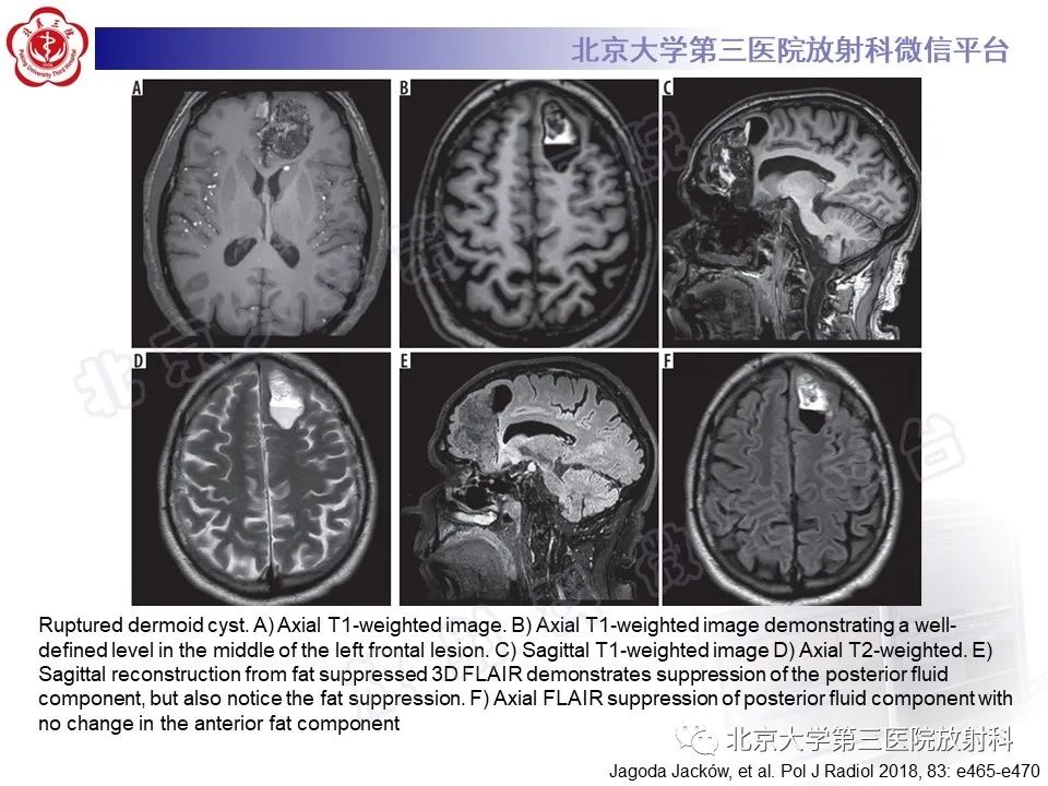 【PPT】颅内皮样囊肿-26