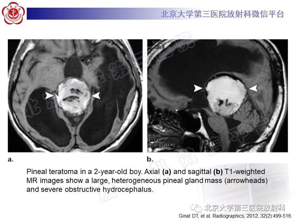 【PPT】颅内皮样囊肿-30