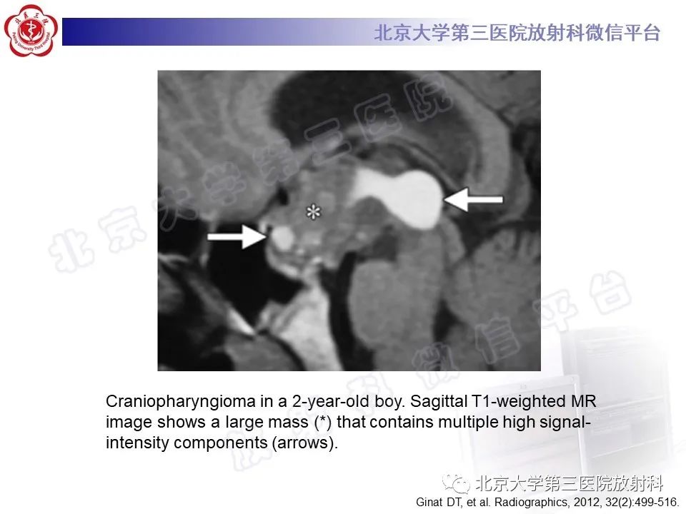 【PPT】颅内皮样囊肿-32