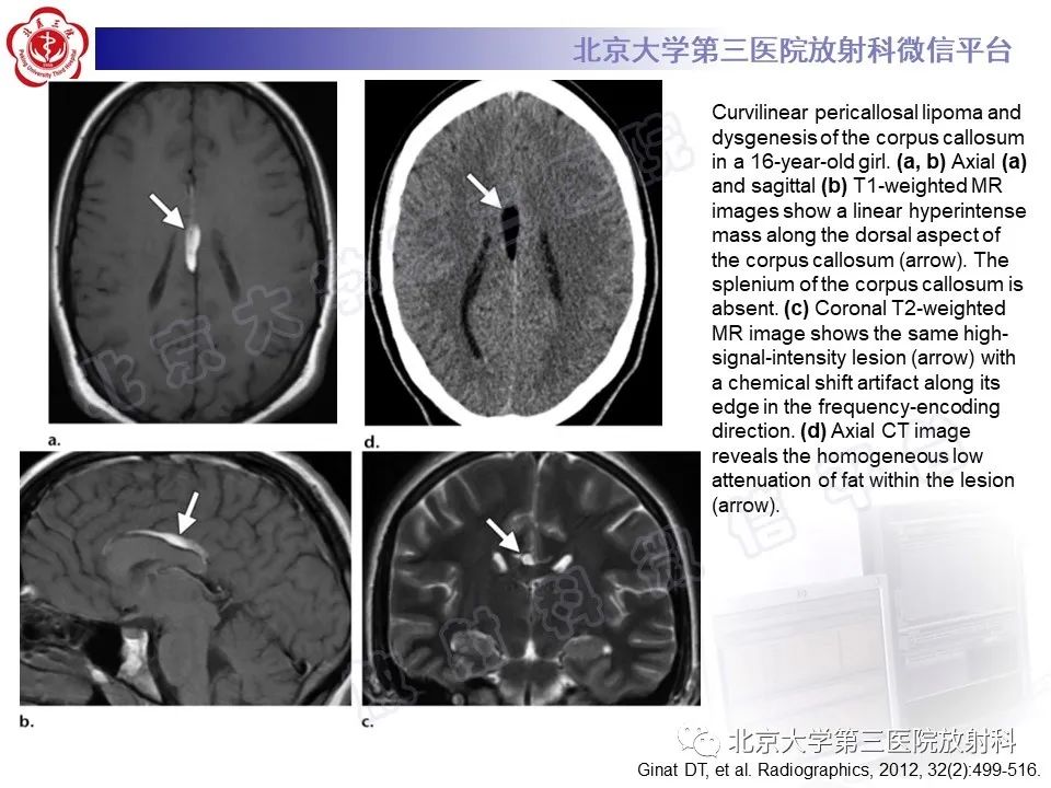 【PPT】颅内皮样囊肿-34