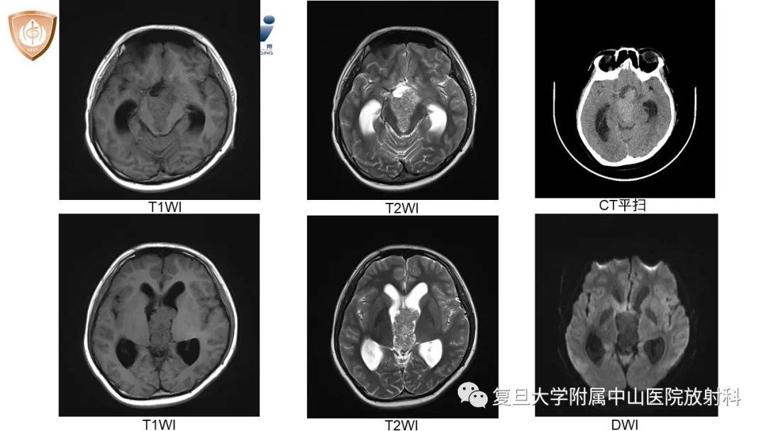 【病例】颅咽管瘤2例CT及MR影像-3
