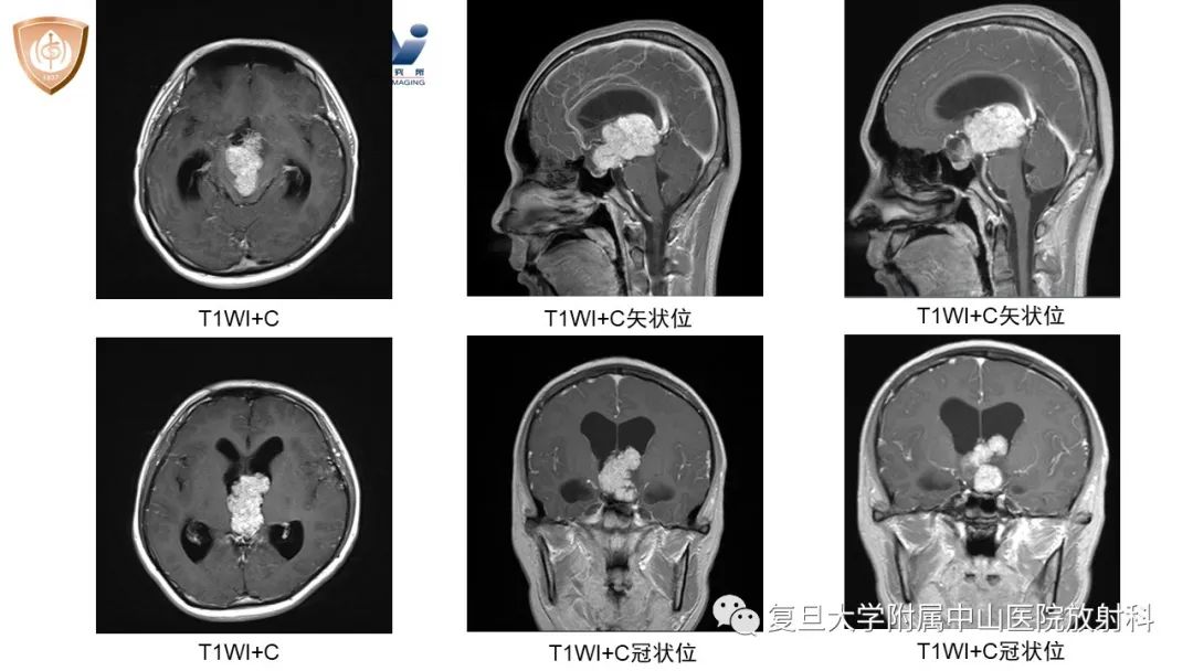 【病例】颅咽管瘤2例CT及MR影像-4