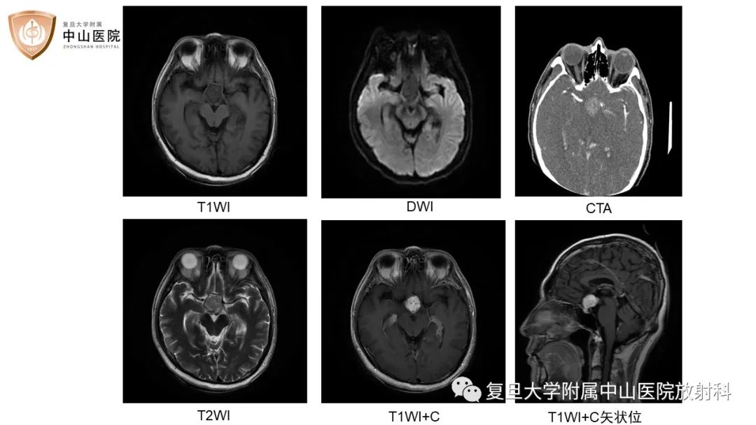 【病例】颅咽管瘤2例CT及MR影像-7