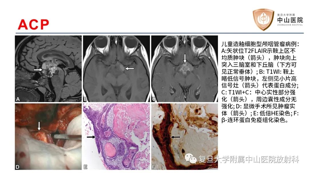 【病例】颅咽管瘤2例CT及MR影像-14