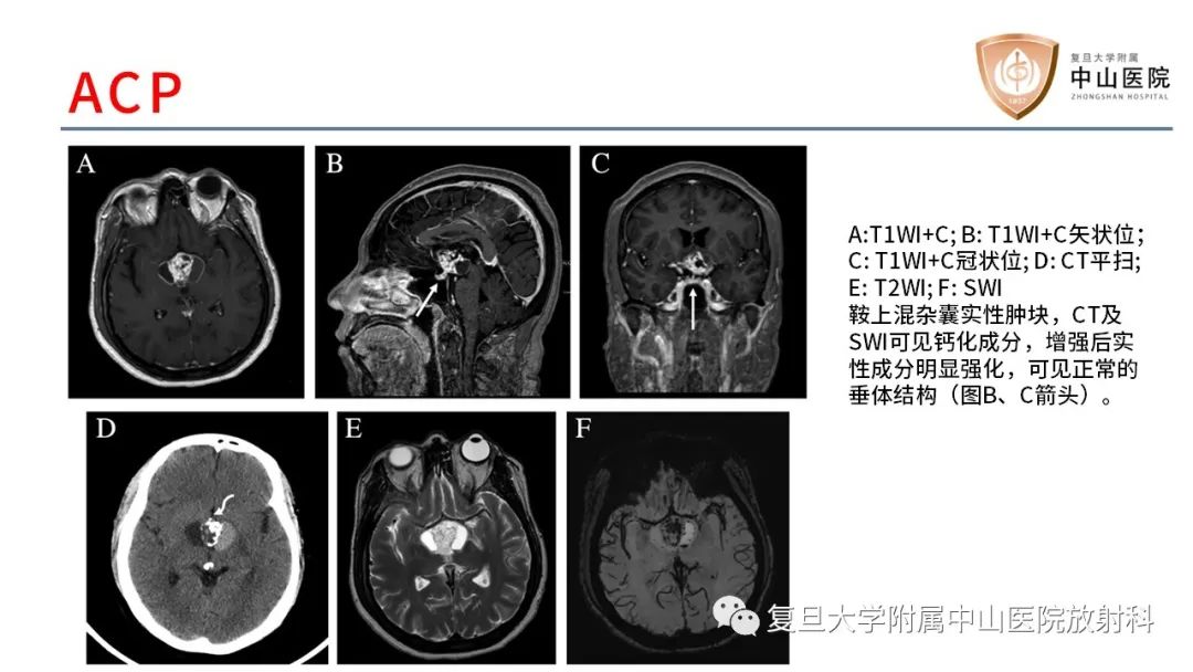 【病例】颅咽管瘤2例CT及MR影像-15