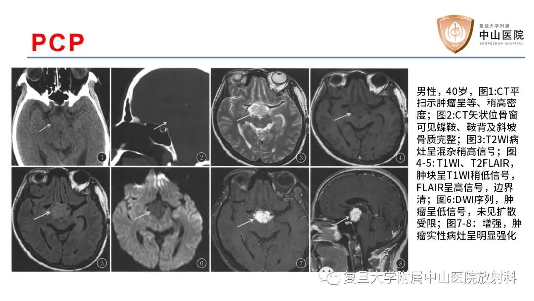 【病例】颅咽管瘤2例CT及MR影像-16