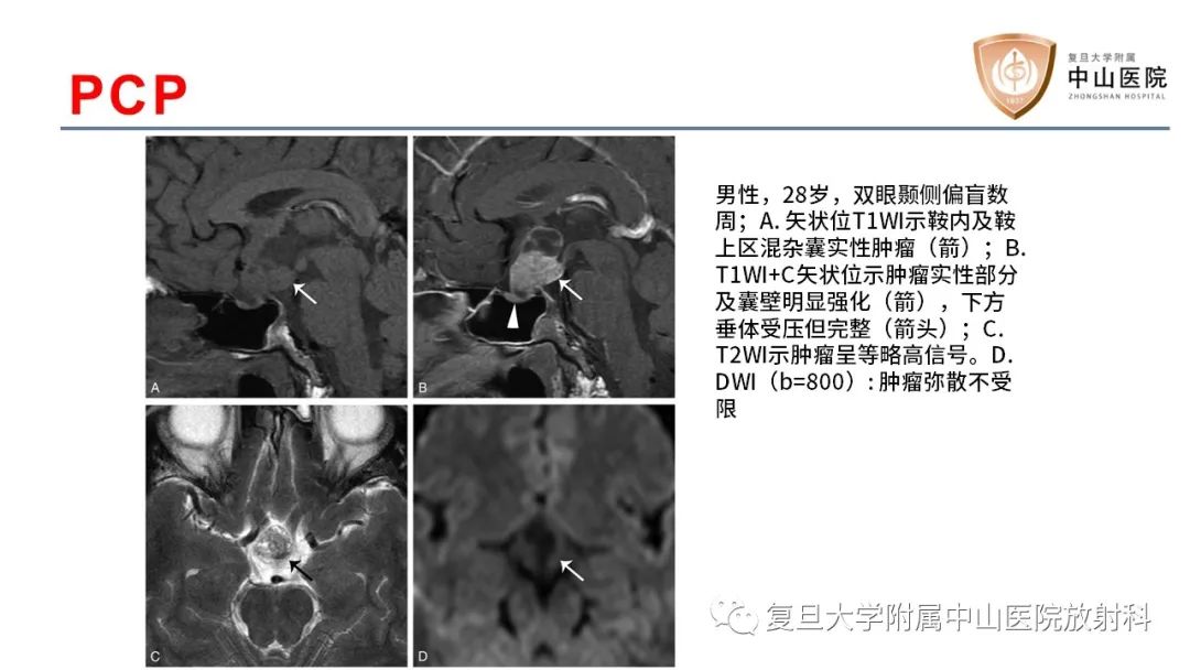 【病例】颅咽管瘤2例CT及MR影像-17