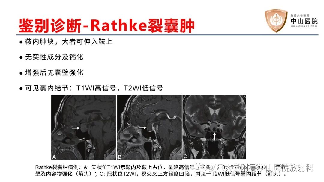 【病例】颅咽管瘤2例CT及MR影像-19