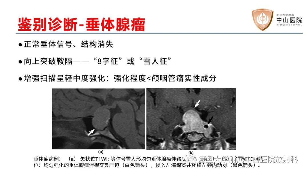 【病例】颅咽管瘤2例CT及MR影像-18
