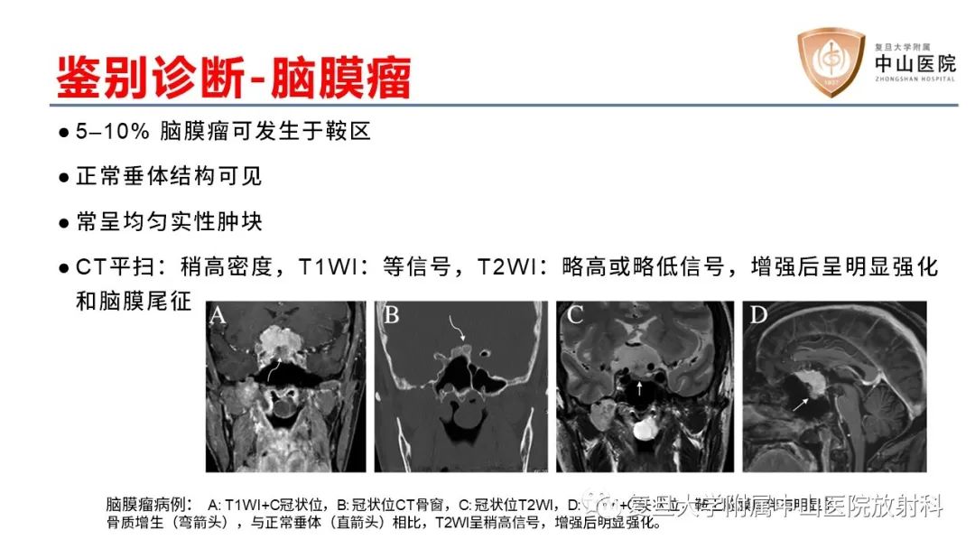 【病例】颅咽管瘤2例CT及MR影像-20